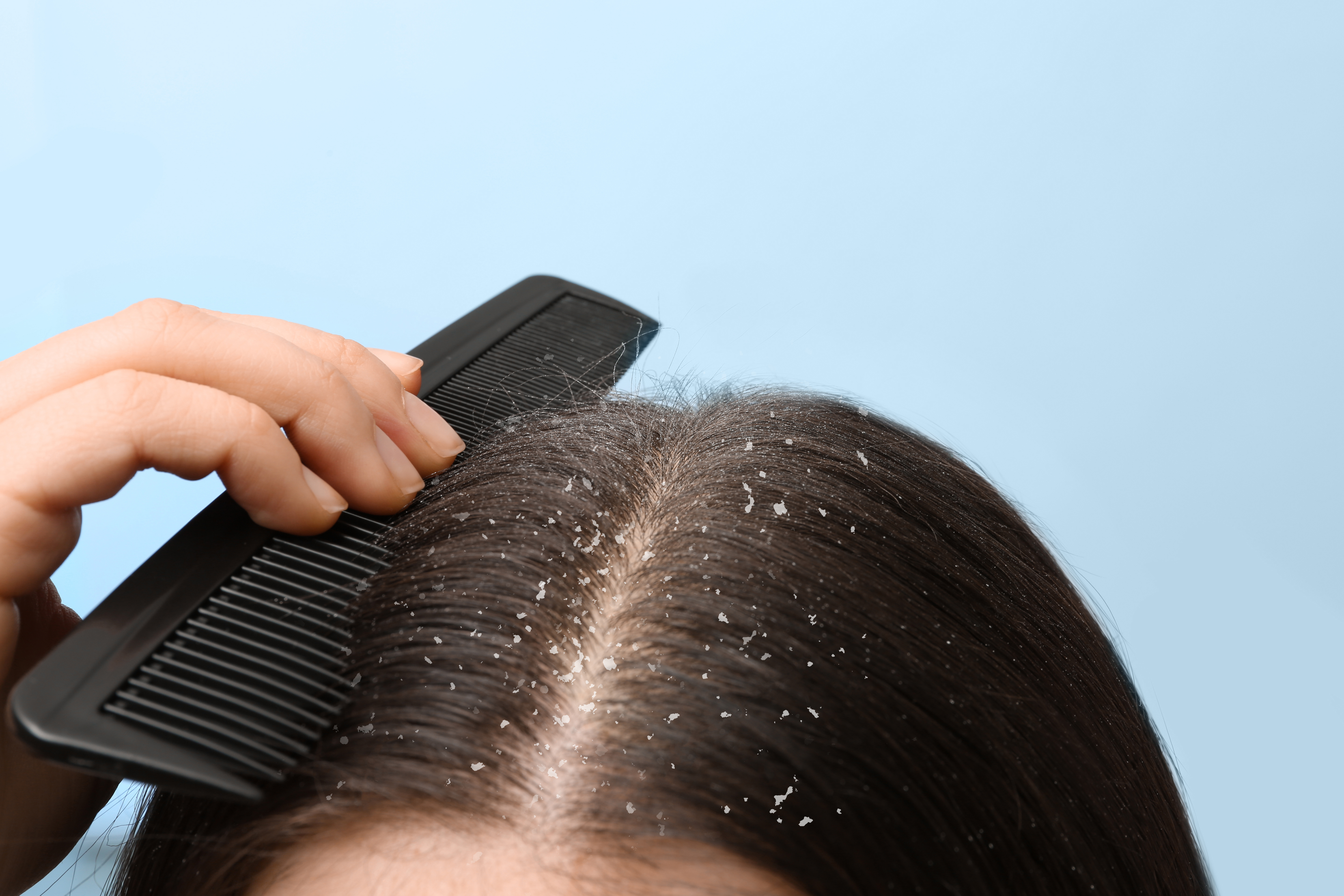 Does Dandruff Cause Hair Fall