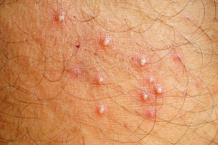 Folliculitis Treatment Cost in Mumbai