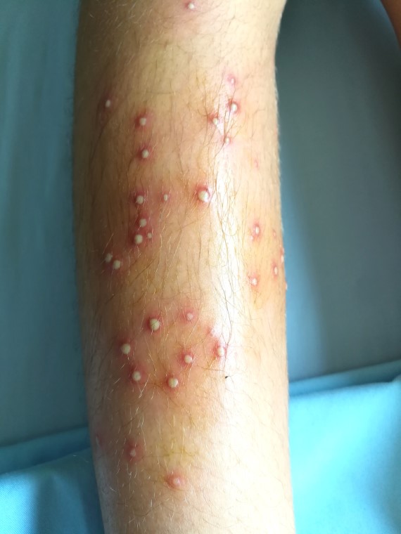 Folliculitis treatment