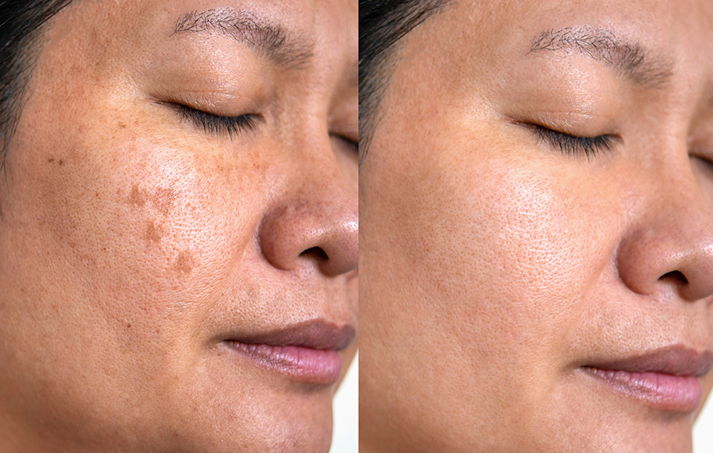 q switch laser treatment for pigmentation | advanced technology for precise targeting
