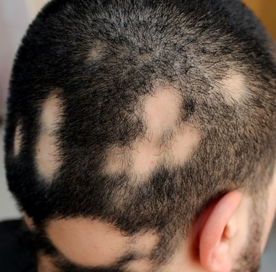 alopecia areata
