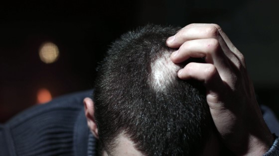 alopecia hair loss