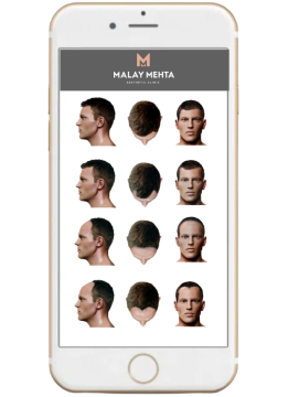 baldness calculator