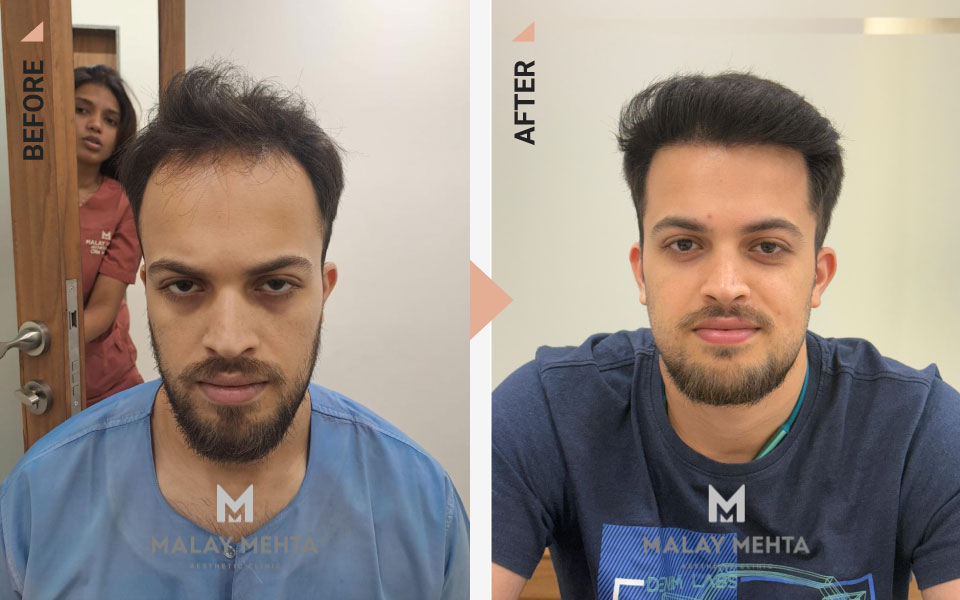 31-Year-Old Male Sapphire FUE Before & After