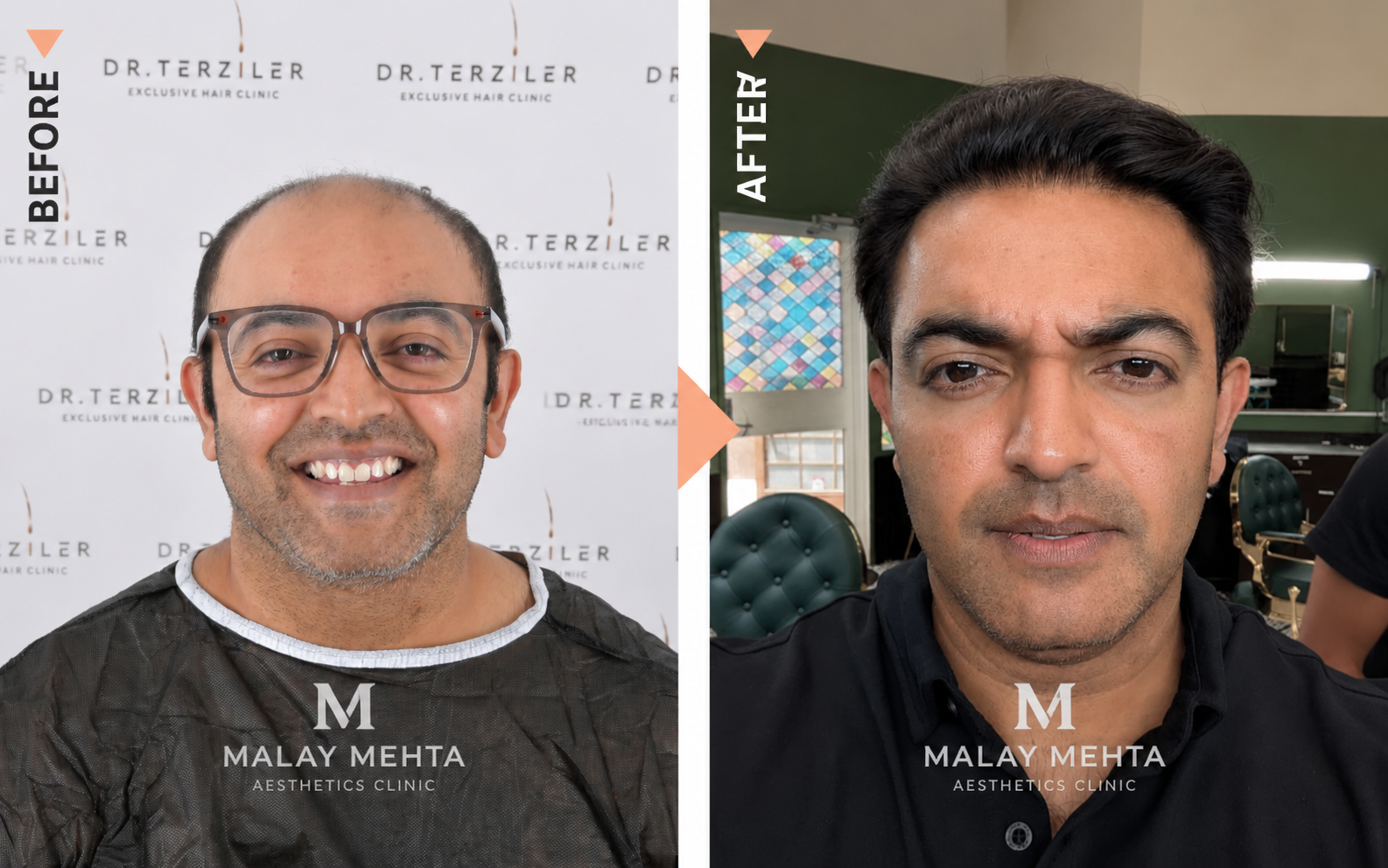 corrective failed hair transplant 47 male