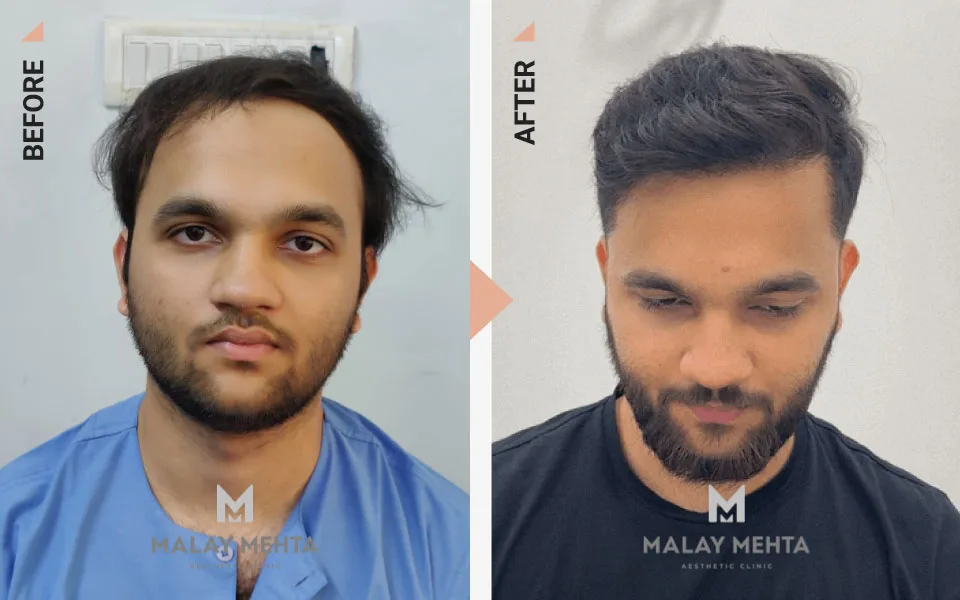 22-Year-Old Male Sapphire FUE Before & After