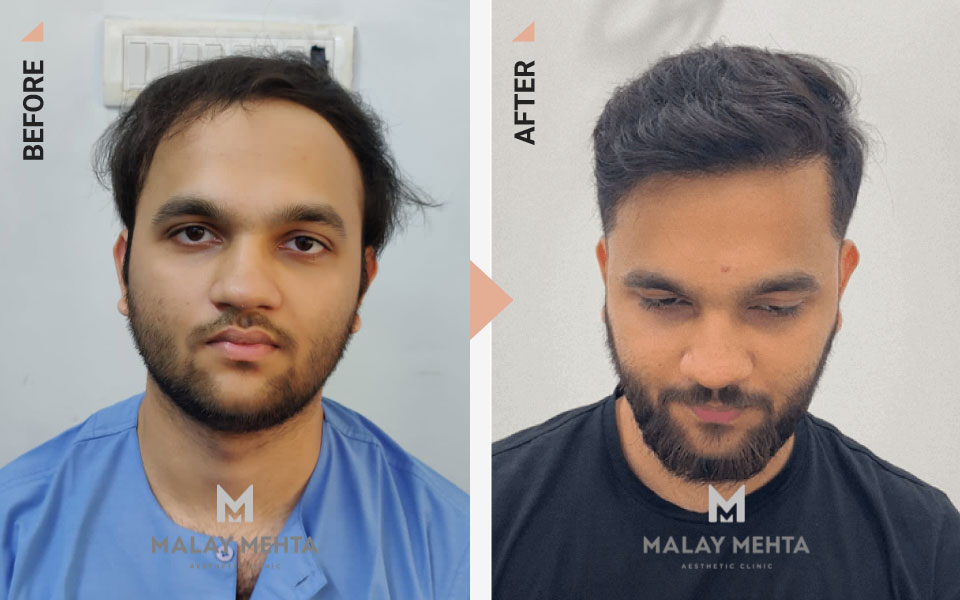 22-Year-Old Male Sapphire FUE Before & After