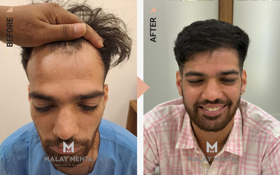 28-Year-Old Male Sapphire FUE Before & After