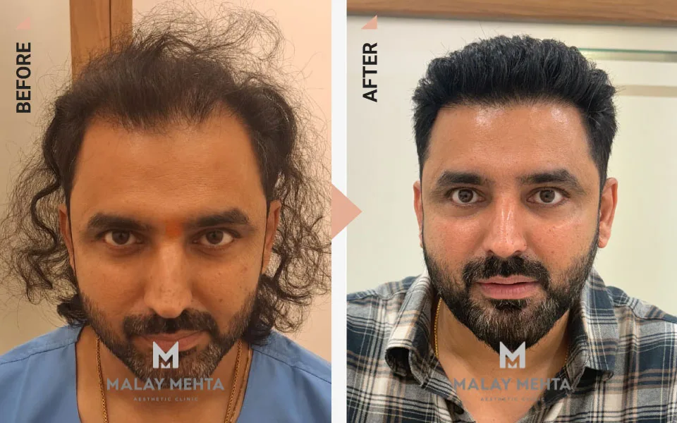 34-Year-Old Male Corrective Transplant Before & After
