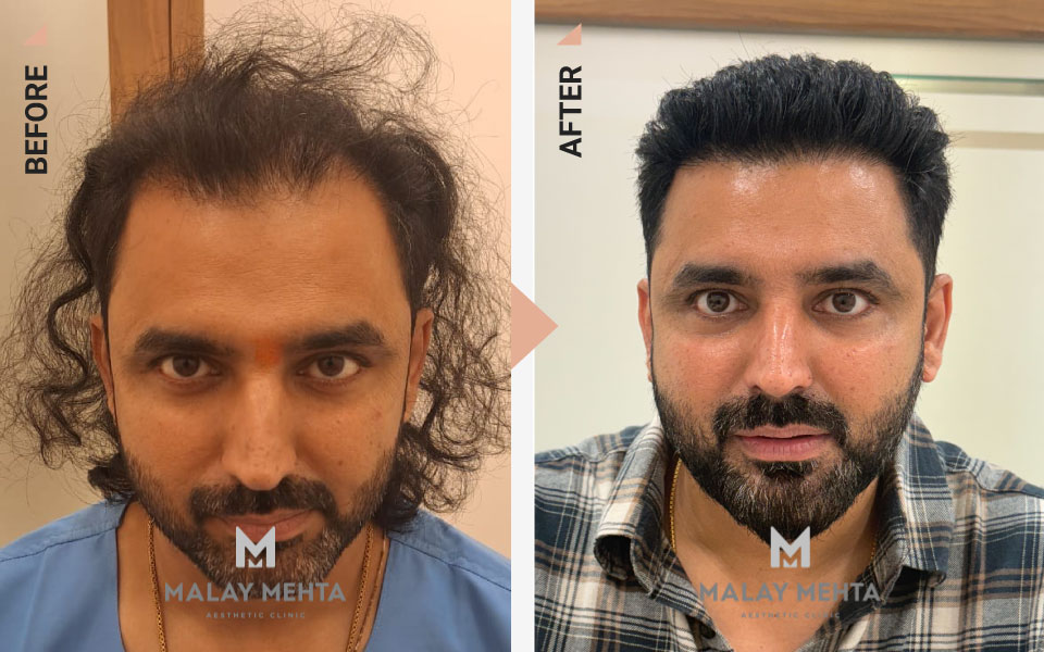 34-Year-Old Male Corrective Transplant Before & After