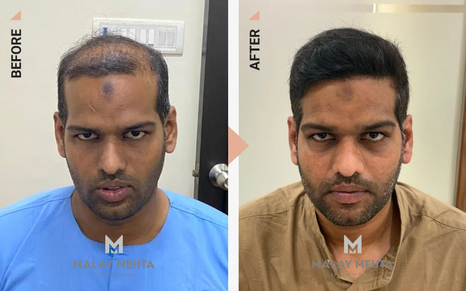32-Year-Old Male Advanced Restoration Before & After