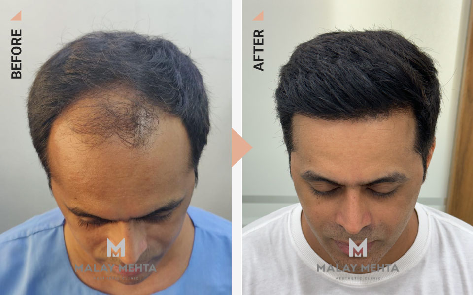 40-Year-Old Male Sapphire FUE 3,500 Grafts Before & After