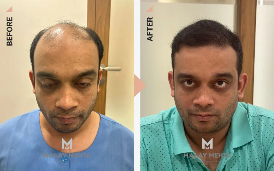 42-Year-Old Male Advanced Restoration Before & After