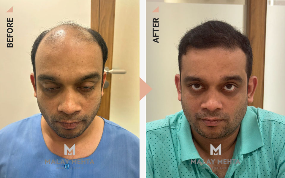 42-Year-Old Male Advanced Restoration Before & After