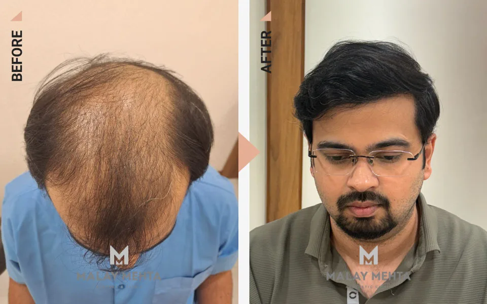 26-Year-Old Male Sapphire FUE Before & After
