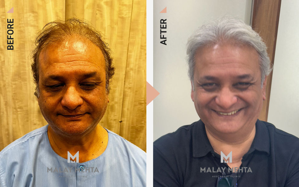 64-Year-Old Male Scalp + Beard Donor Before & After