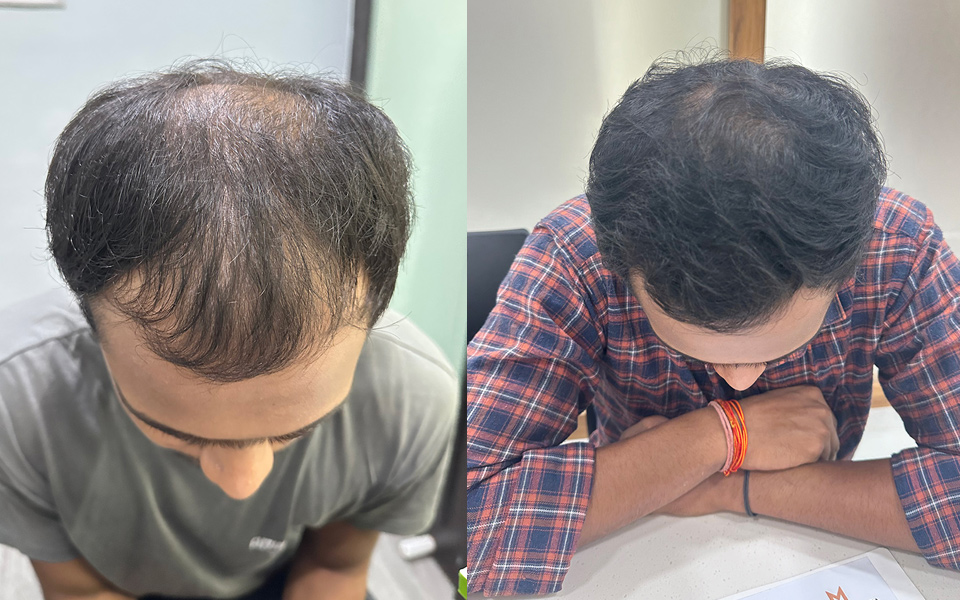 hair loss treatment mumbai