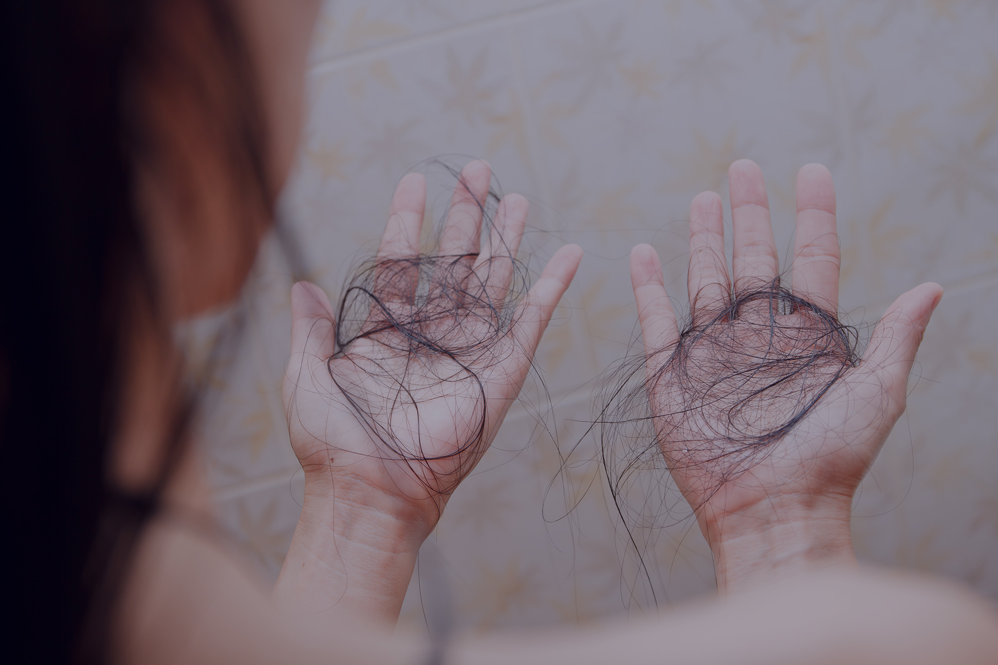 Can A Thyroid Problem Cause Hair Loss?