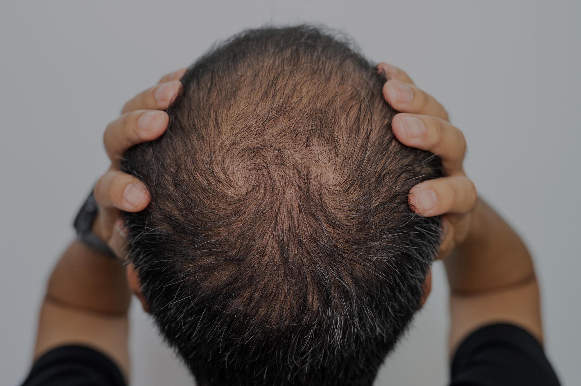 Is Your Hairline Changing? Early Signs of Balding