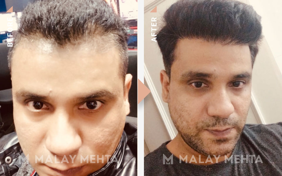 Long Hair Transplant Result before after