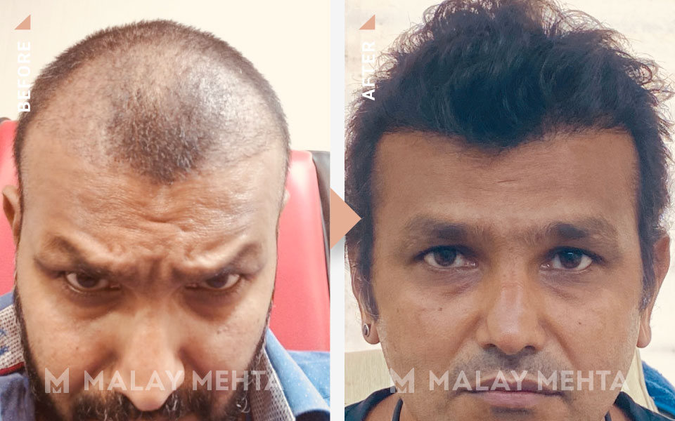 37-Year-Old Male Long Hair Transplant before after