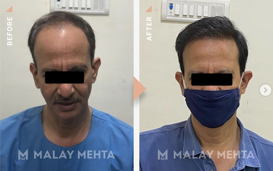55-Year-Old Male Long Hair Transplant before after