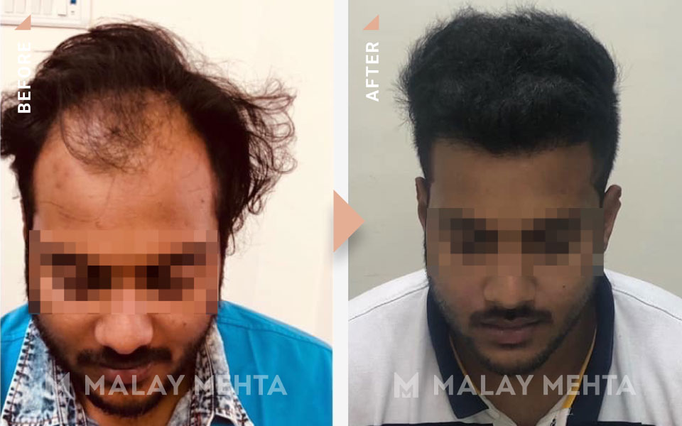 28-Year-Old Male Long Hair Transplant before after