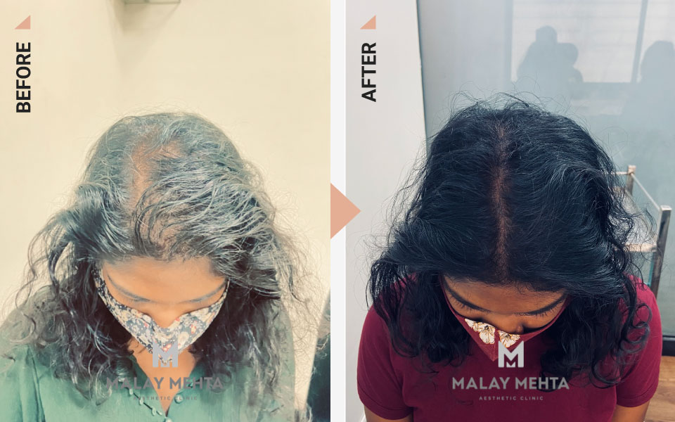 gfc treatment for hair before after