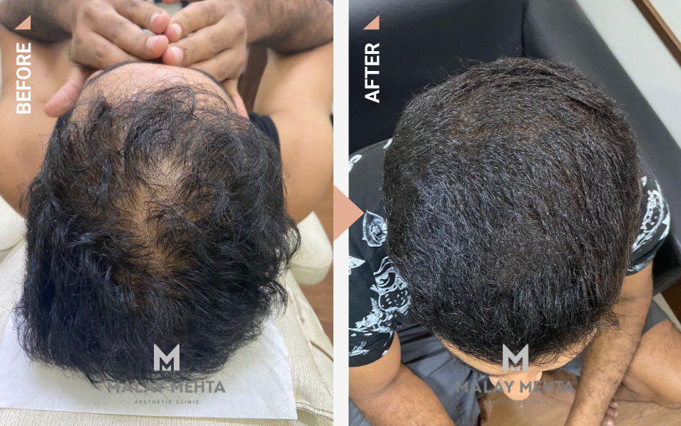 growth factor concentrate for hair mumbai before after