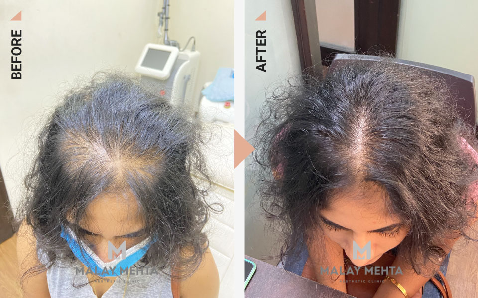 growth factor concentrate for hair mumbai before after