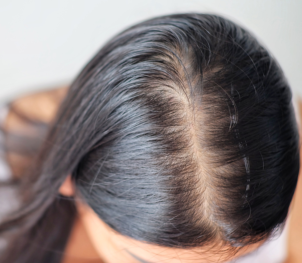 hair loss treatment mumbai