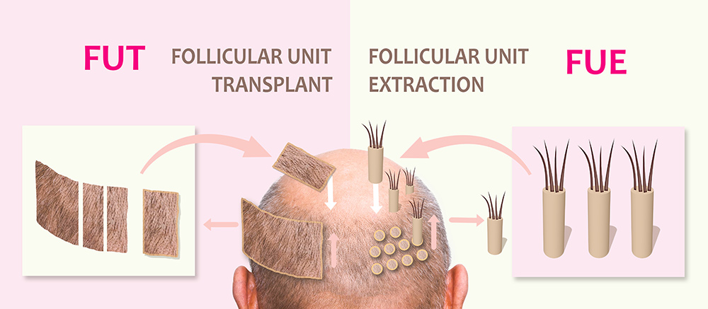 Types of Hair Transplant | Hair Transplant Techniques | Process of Hair Transplant