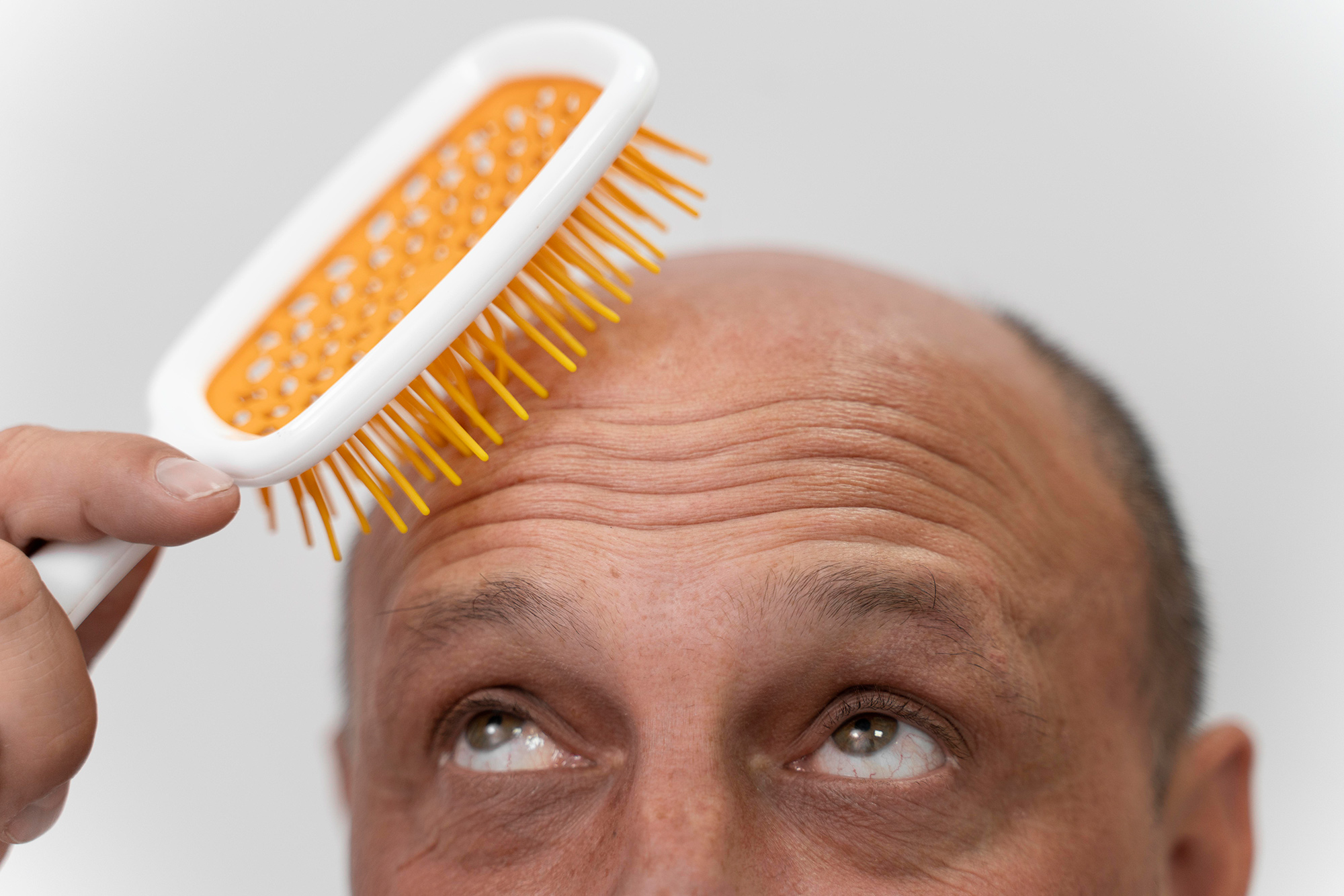 The Journey To Luscious Locks: Tracking Hair Transplant Growth Over Time