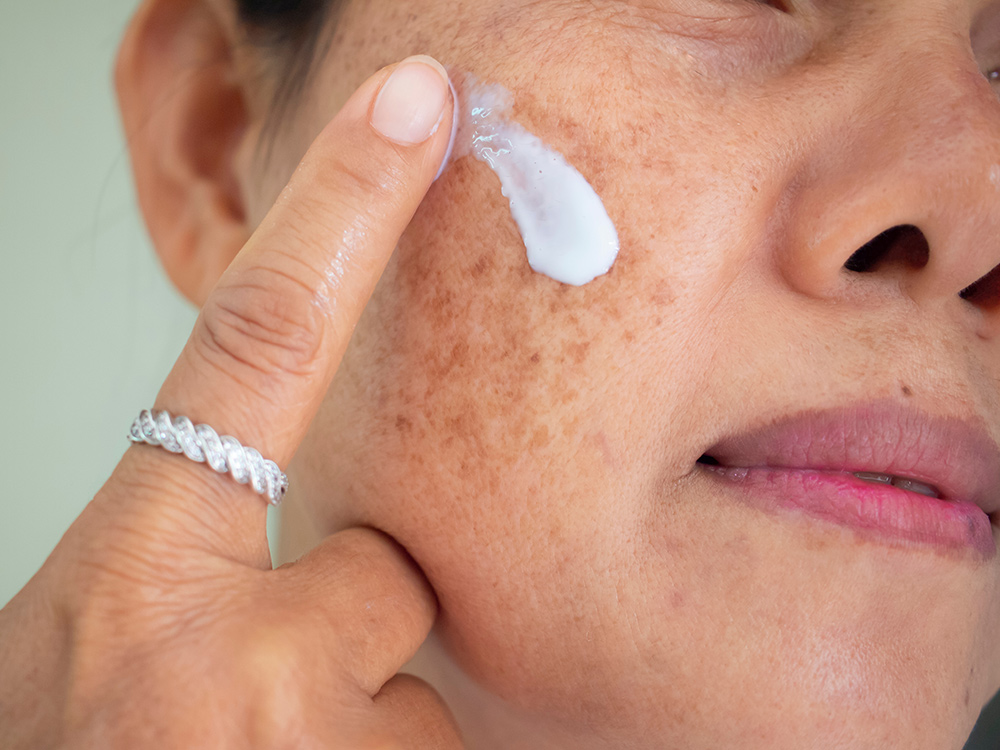 Hyperpigmentation Treatment | Skin Pigmentation | What is Pigmentation On Face
