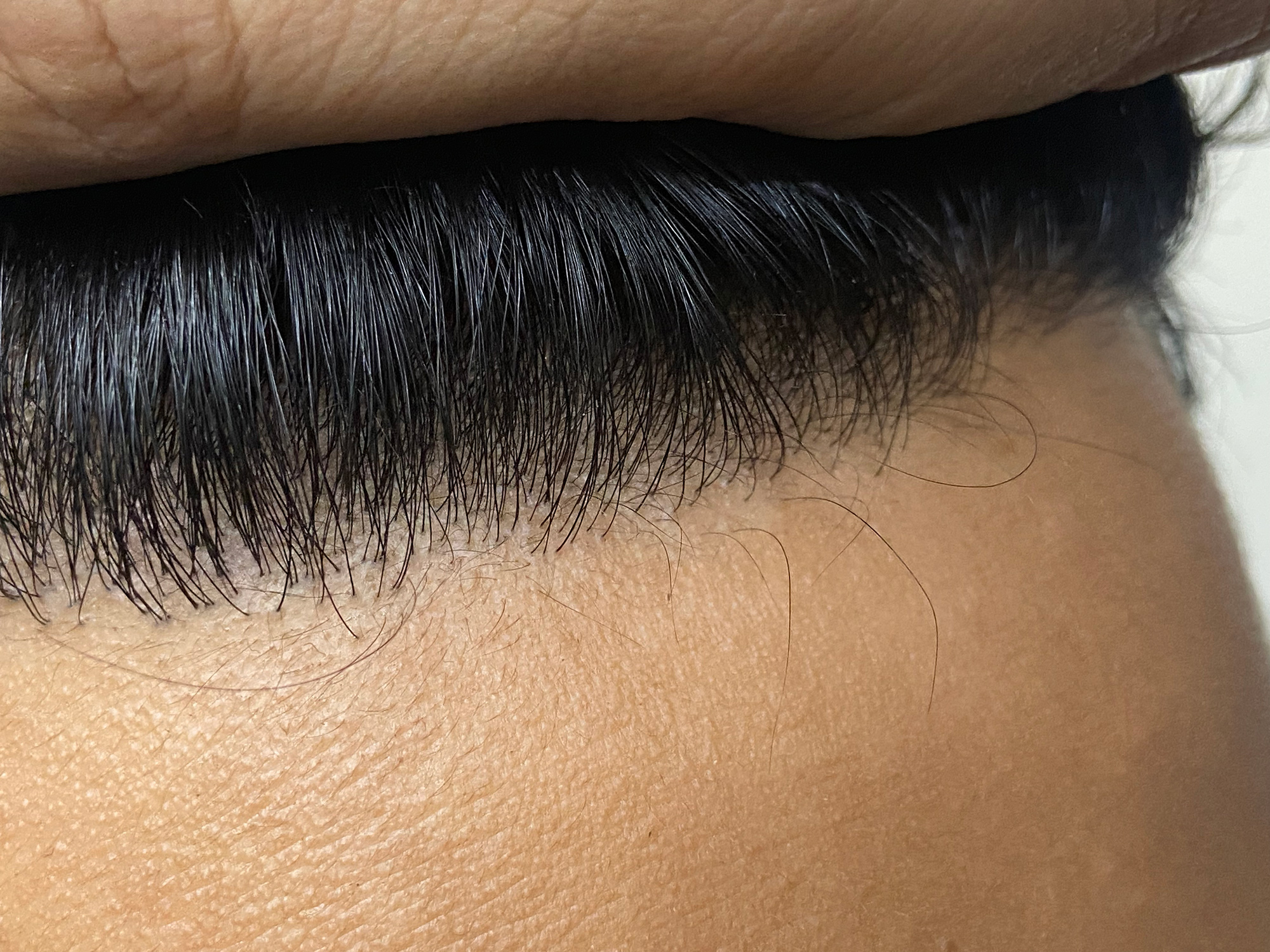 All You Need to Know About The Latest Hair Transplant Technology