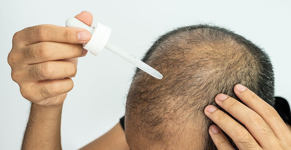 10 Things You Should Know About Minoxidil for Hair Growth