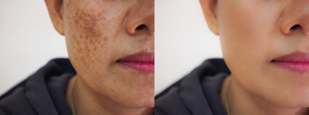 What is Pigmentation on Face | Skin Pigmentation | Hyperpigmentation