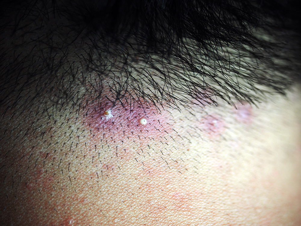 Essential Tips for Preventing and Healing Folliculitis Scarring