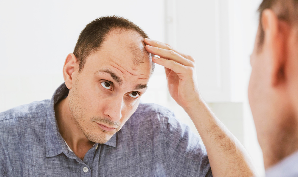 Receding Hairline Stages, Causes and Prevention