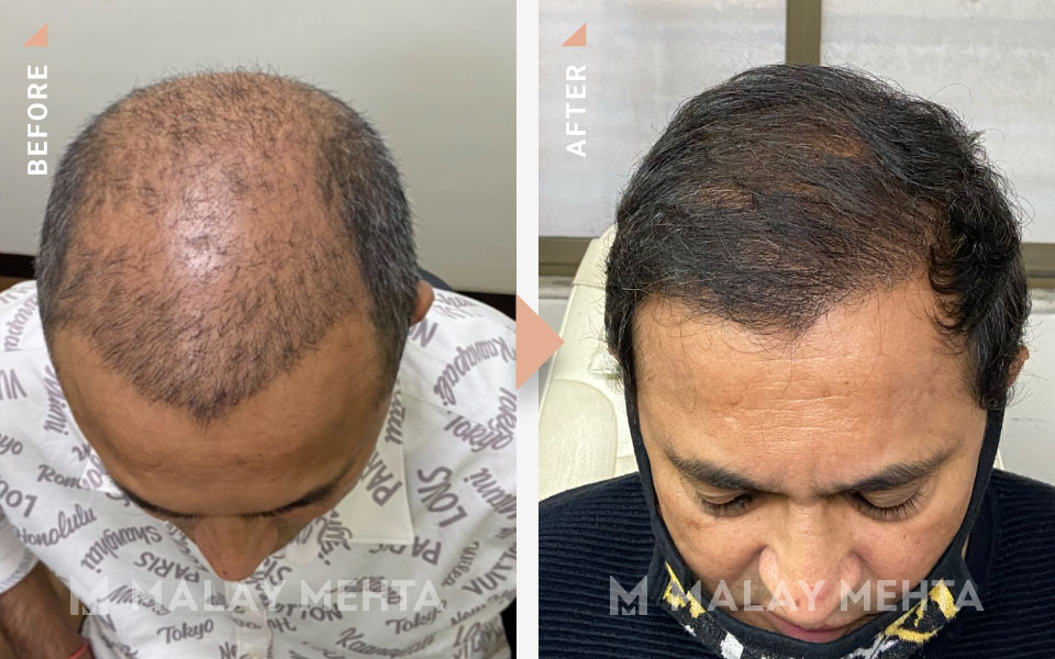 revision surgery before after