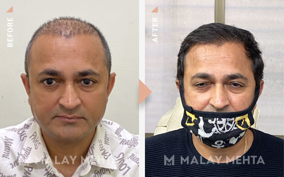 revision surgery before after