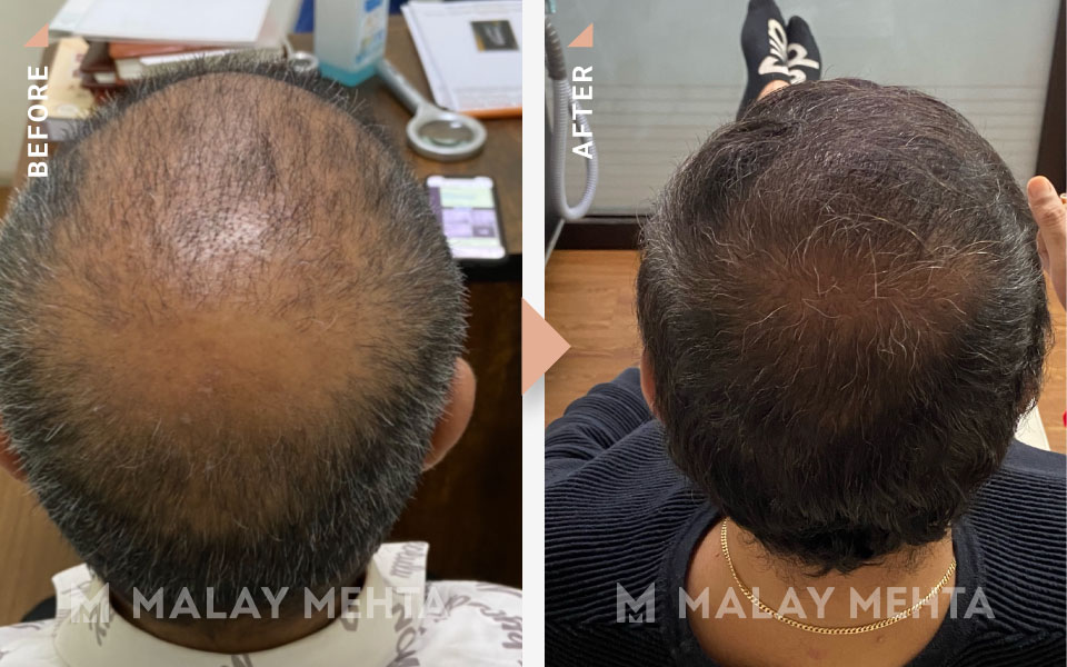 revision surgery before after