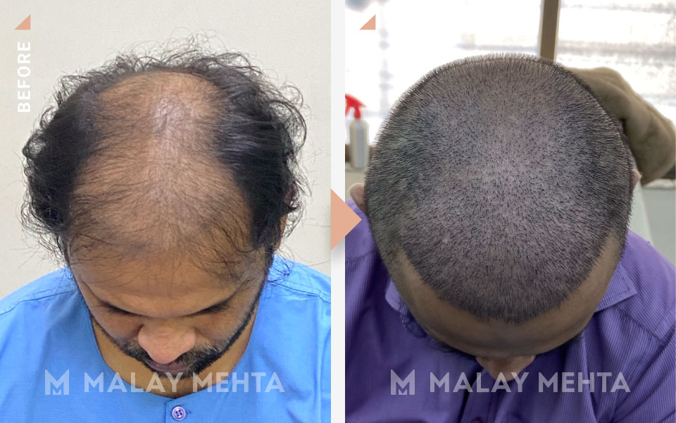 revision surgery before after