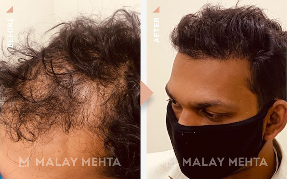 revision surgery before after