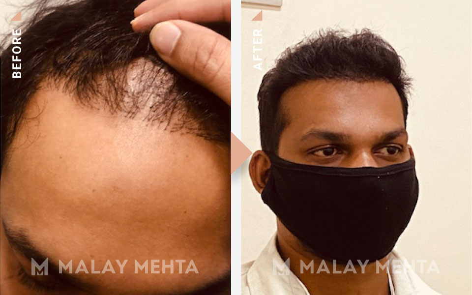 revision surgery before after