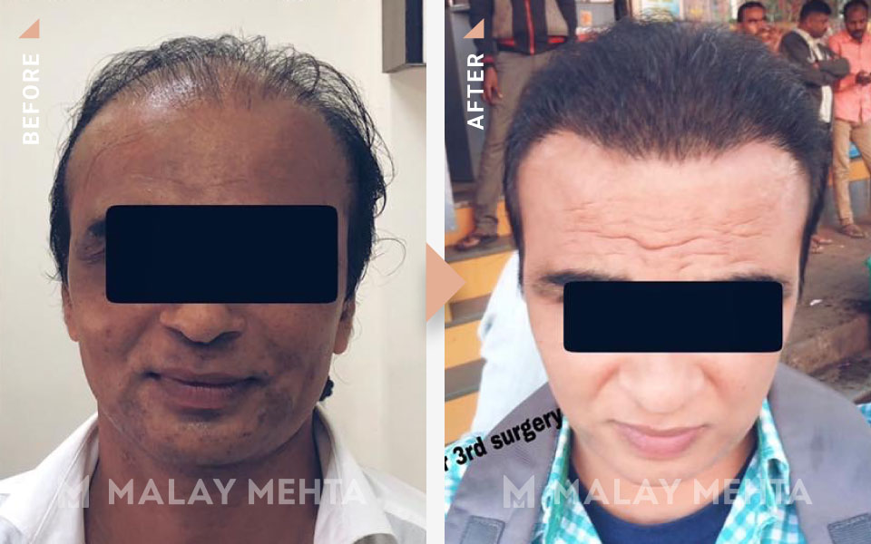 revision surgery before after