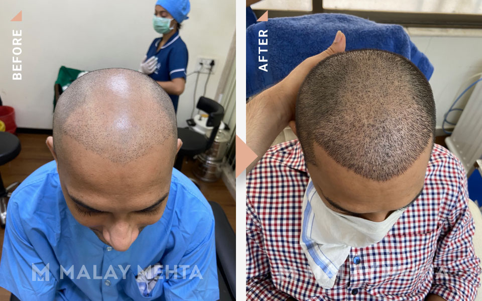 revision surgery before after