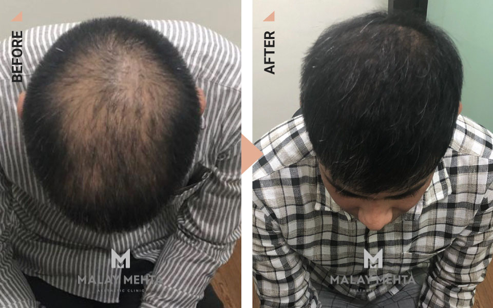 scalp micropigmentation in mumbai