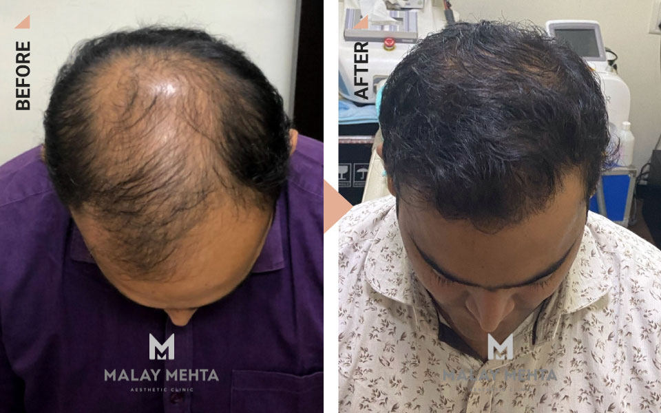 scalp micropigmentation mumbai