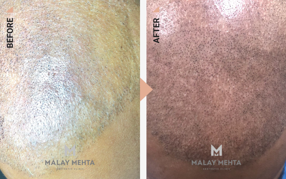 scalp micropigmentation mumbai before after